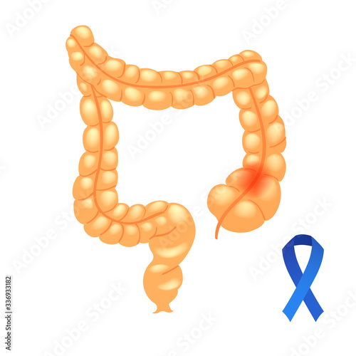 Realistic high detailed vector illustration of colon with cancer. Cancer ribbon.