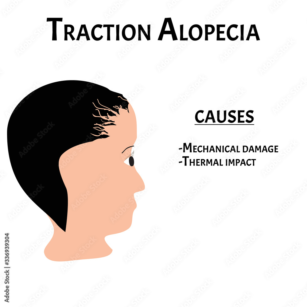 Alopecia hair. Baldness of hair on the head. Traction alopecia causes. Infographics. Vector illustration on isolated background.