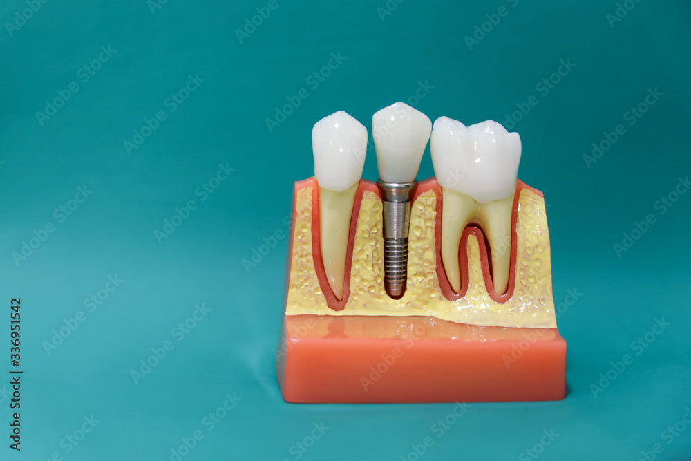 Obraz premium background of dental implant model close up with copy space
