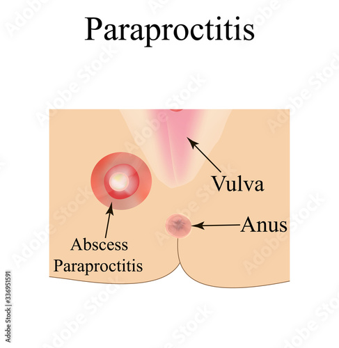 Paraproctitis. Abscess in the perineum. Inflammation paraproctitis. Infographics. Vector illustration on isolated background.