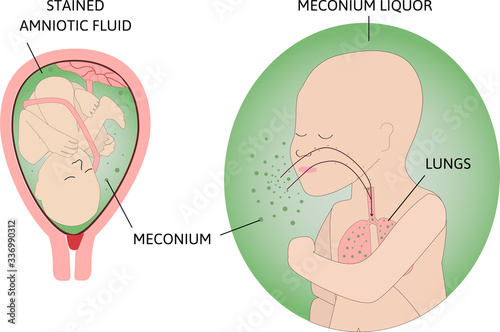 the process of Meconium aspiration syndrome MAS also known as neonatal aspiration of meconium. Fetus in womb. Mecinium around him. Child makes a breathe with green amniotic fluid.