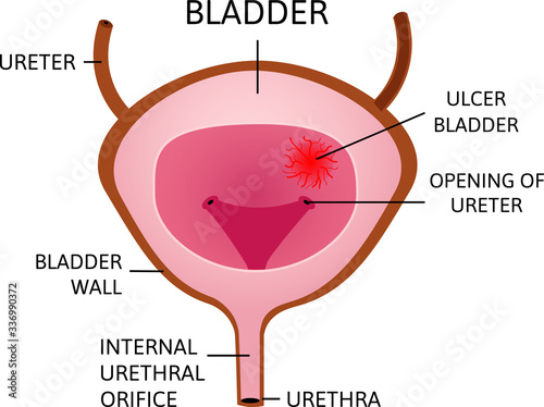 Bladder ulcer. Red and oval ucler inside the bladder caviry. Desease. Strong pain. photo