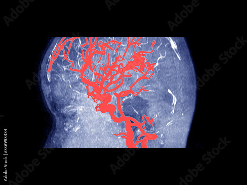 MRI OF THE BRAIN AND MRA & MRV OF THE BRAIN. photo