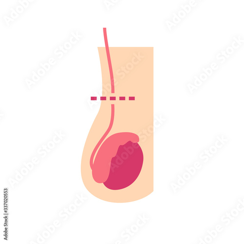 vasectomy flat icon, vector illustration