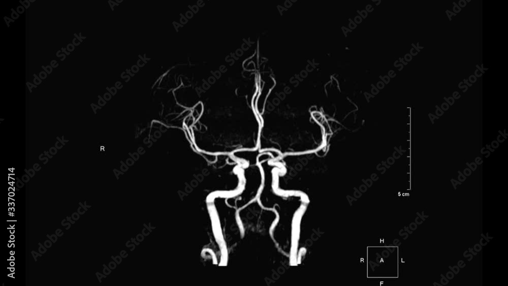 MRA Brain or Magnetic resonance angiography of Cerebral artery in the brain turn around on the screen. MRA Brain MIP view for evaluate cerebral artery disease. MRA Brain or Magnetic resonance angiography of Cerebral artery in the brain turn around on the screen. MRA Brain MIP view for evaluate cerebral artery disease.