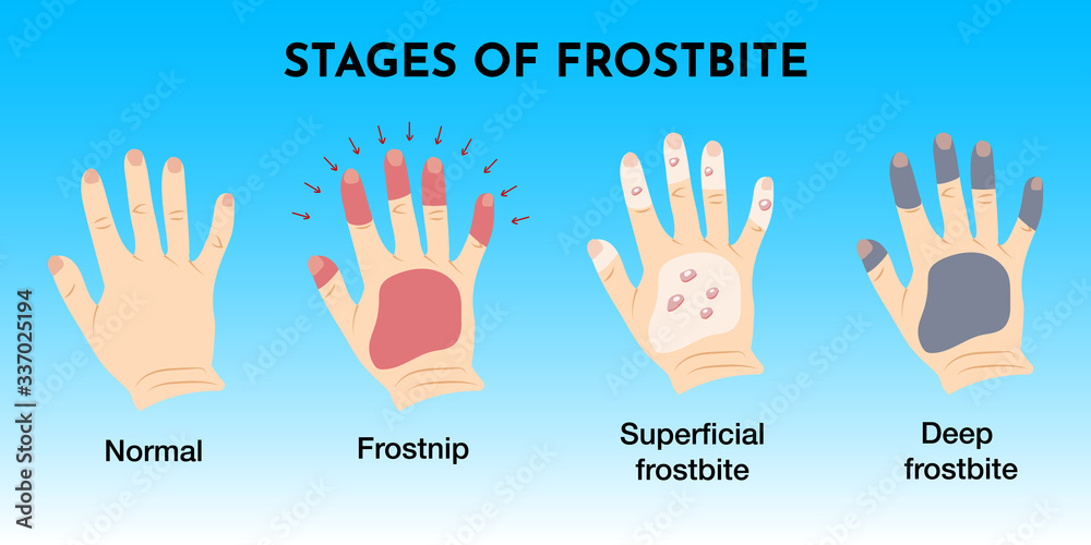 Medical frostbite stage and first aid infographic. Frozen hands with