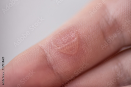 Blister on Human Finger. Selected focus. photo