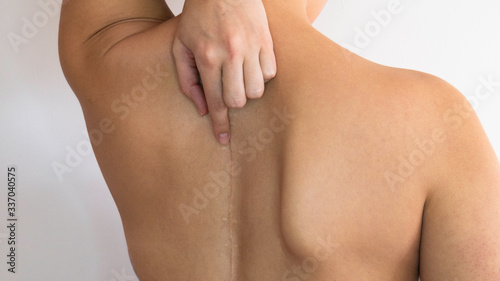 The scar on the bare back of a woman.