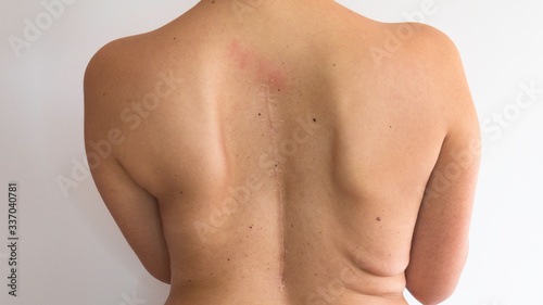 Scoliosis - Curved naked back of a woman with scar of spinal surgery.