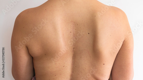 Scoliosis of the spine. Curved woman's back with a scar from spine surgery.