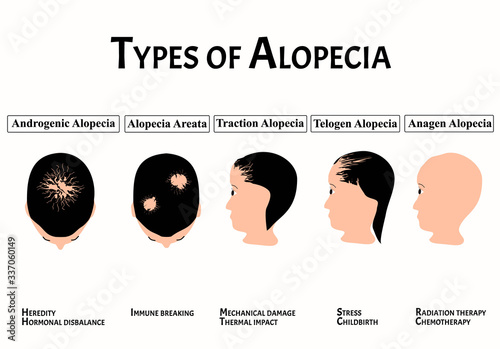 Types of alopecia. Bald spot, baldness, Alopecia mesotherapy. Causes of baldness. Infographics. Vector illustration on isolated background.