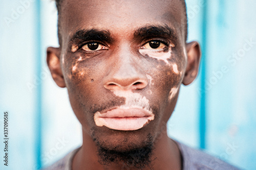 Portrait of a brown skin man with vitiligo