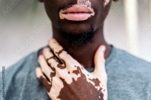 Midsection of young man with vitiligo photo