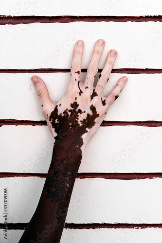 hand up isolated of a man with vitiligo. photo