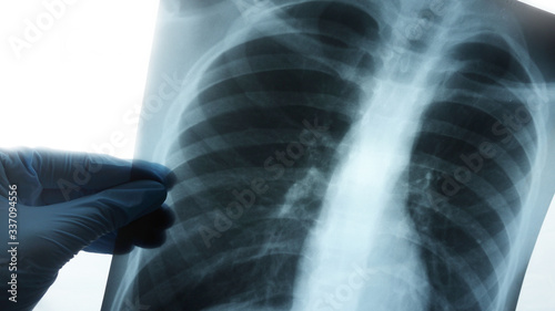 A x-ray of teenager lungs. Doctor look roentgen for diagnostic pneumonia covid-19. Concept coronavirus theme.