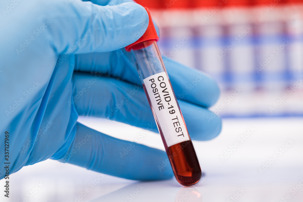 Coronavirus blood test concept. A test tubes with Coronavirus positive blood over laboratory desk. Covid-19 concept can be used Coronavirus blood test concept. A test tubes with Coronavirus positive blood over laboratory desk. Covid-19 concept can be used