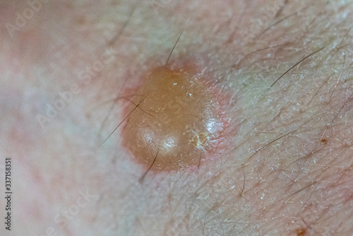 Clinical Photograph of a Second Degree Burn Sustained from a Drop of Hot Grease