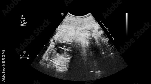 Ultrasound screen with fetal echocardiography