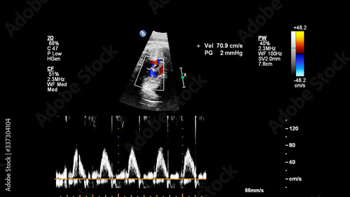 Ultrasound screen with fetal echocardiography