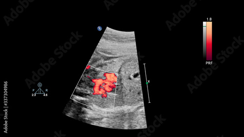 Ultrasound screen with fetal echocardiography