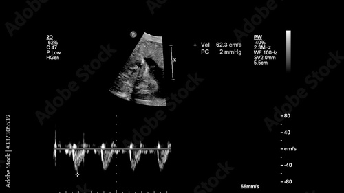 Ultrasound screen with fetal echocardiography