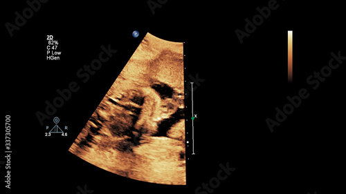 Ultrasound screen with fetal echocardiography