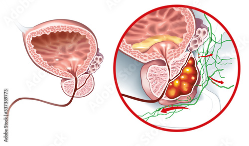 Prostate cancer and healthy prostate, medically accurate illustration photo