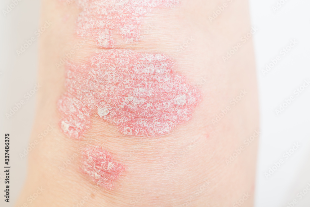 Acute psoriasis on the knees is an autoimmune incurable dermatological skin disease. Large red, inflamed, flaky rash on the knees. Joints affected by psoriatic arthritis.Close up Acute psoriasis on the knees is an autoimmune incurable dermatological skin disease. Large red, inflamed, flaky rash on the knees. Joints affected by psoriatic arthritis.Close up