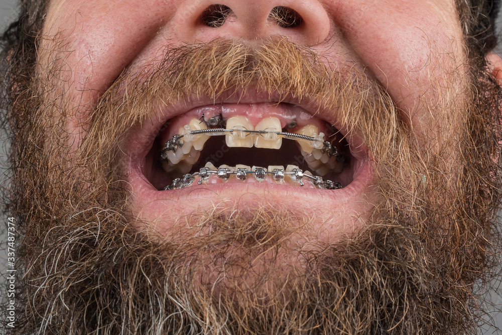 Two dental implants on upper jaw and metal braces on both rows of teeth