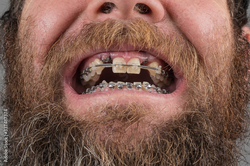 Two dental implants on upper jaw and metal braces on both rows of teeth. Lower braces seen with dented wire to align lower row of teeth, tooth number 3 and 4. Ortodontic accesories in mouth photo