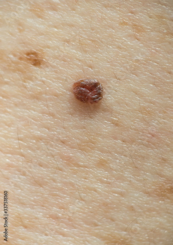 Mole on human skin