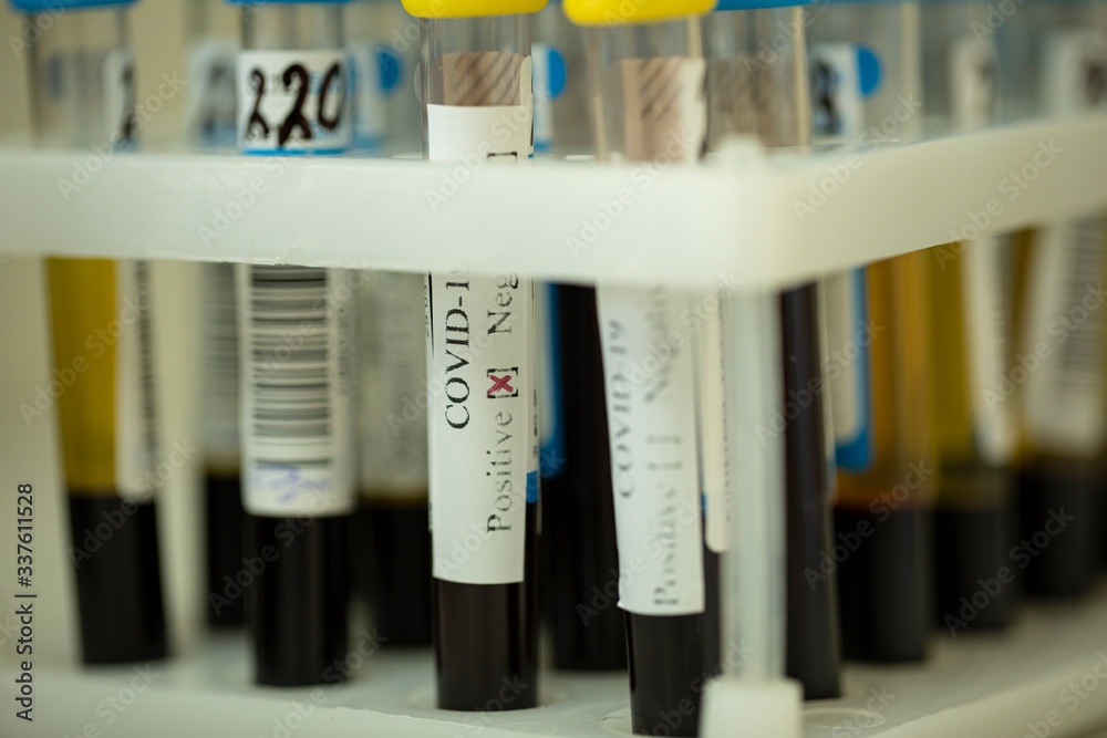 Close up rack with lab tubes of biological samples, coronavirus positive test