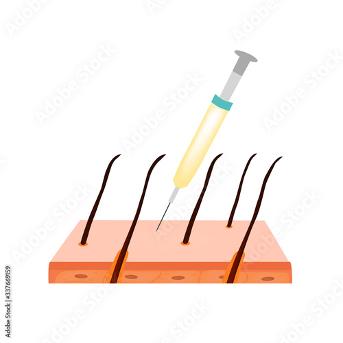 Treatment of alopecia. Bald spot, baldness, Alopecia mesotherapy. Infographics. Vector illustration on isolated background.