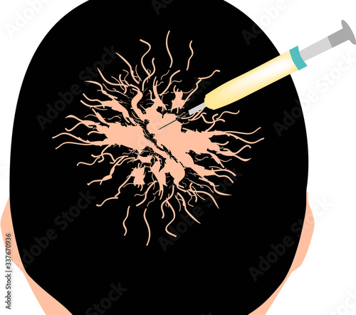 Treatment of alopecia. Bald spot, baldness, Alopecia mesotherapy. Infographics. Vector illustration on isolated background.