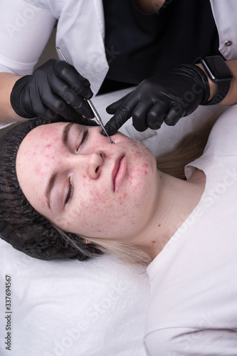 Procedure mechanical face cleaning in beauty salon. Young model getting cosmetic face skin care and treatments in cosmetologist. Acne treatment. Spa, cosmetology and wellness relaxation concept.
