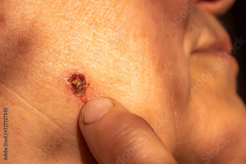 Cauterized wart on an old woman's face. Grandma points to the scar after removing the wart. Sore on the skin.