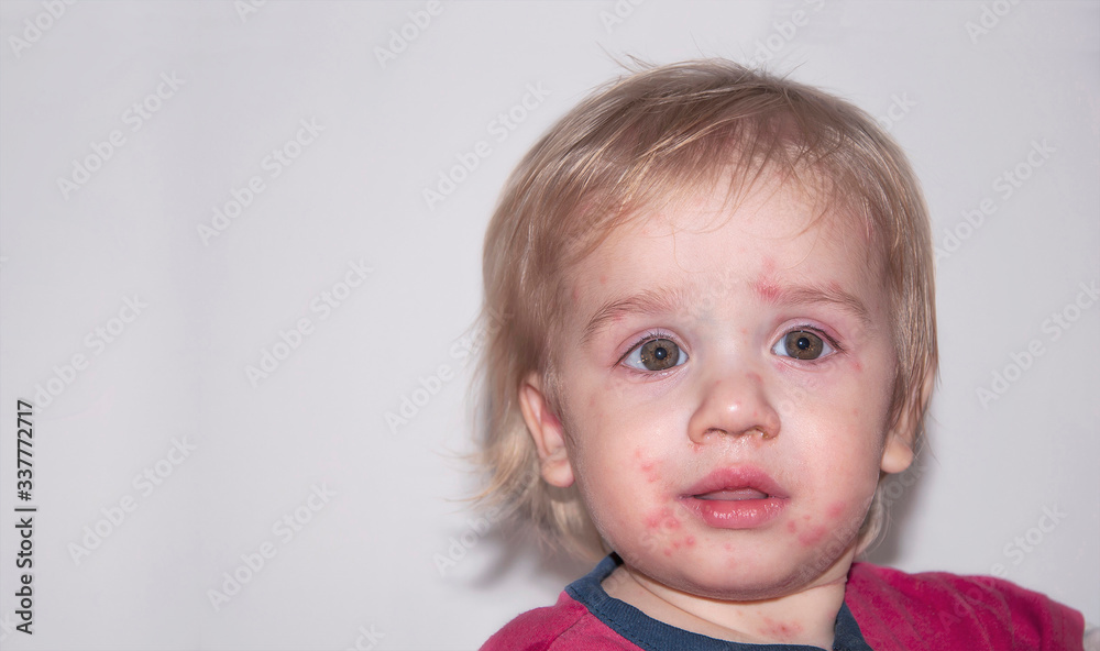 Chickenpox disease, with fever and runny nose. Boy sick on his back. Chickenpox virus, chicken pox outbreak in children. Chickenpox disease, with fever and runny nose. Boy sick on his back. Chickenpox virus, chicken pox outbreak in children.