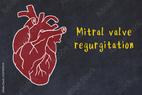 Concept of learning cardiovascular system. Chalk drawing of human heart and inscription Mitral valve regurgitation