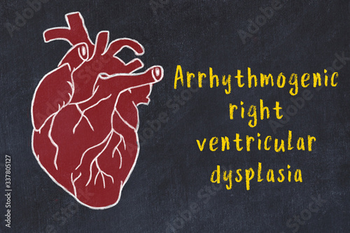 Learning cardio system concept. Chalk drawing of human heart and inscription Arrhythmogenic right ventricular dysplasia photo