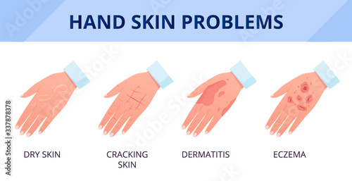 Hand skin problems. Dry skin with cracks, dermatitis and eczema. The consequences of improper care and frequent hand washing and disinfection. Flat vector illustration. photo