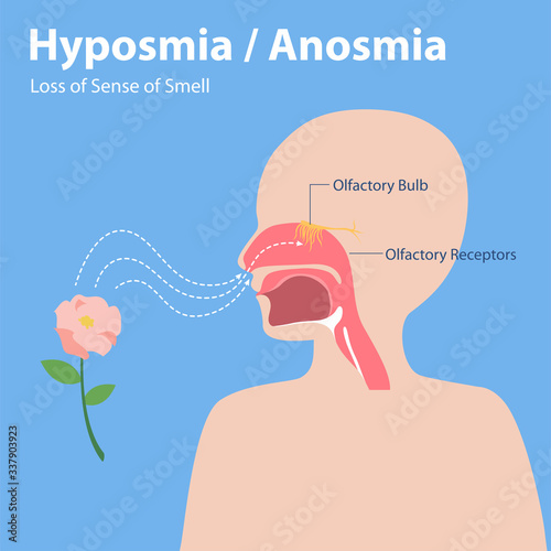 Hyposmia Anosmia, Loss of Sense of Smell Info graphic elements the signs of corona virus Symptoms , Health care concept.