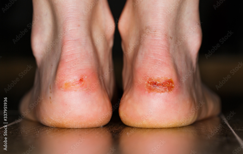 Painful injury on heel