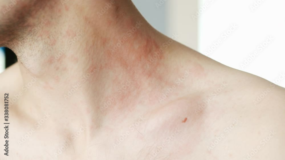 Man scratches a red rash on his neck in close-up. Allergies and skin diseases Man scratches a red rash on his neck in close-up. Allergies and skin diseases