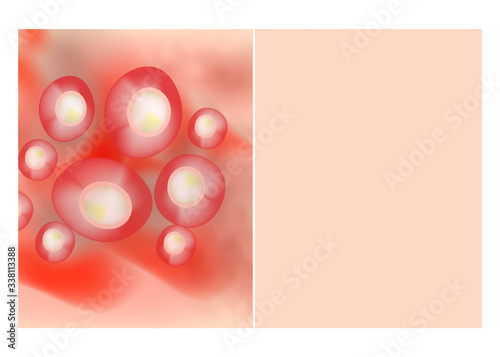 Texture, inflamed pimples and acne. Before After acne cysts. Skin background. Infographics. Vector illustration on isolated background.