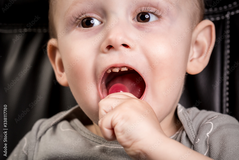 Child eats candy. Boy has caries on teeth. Dental medicine and healthcare Child eats candy. Boy has caries on teeth. Dental medicine and healthcare