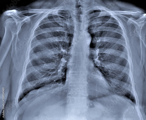 normal chest x-ray, diagnosis of pneumonia