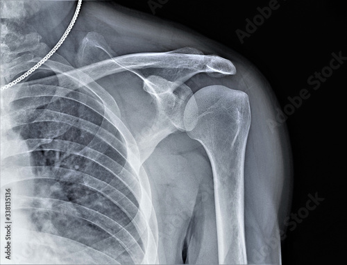 x-ray of the shoulder joint, diagnosis of bone pathology