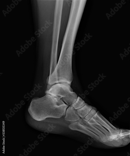 x-ray of the ankle joint  diagnosis of fractures