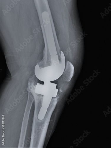 x-ray of the knee joint with a metal endoprosthesis