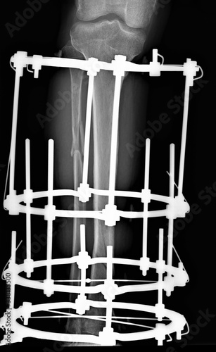 x-ray of the tibia with a fracture of the tibia fixed by an external fixation device